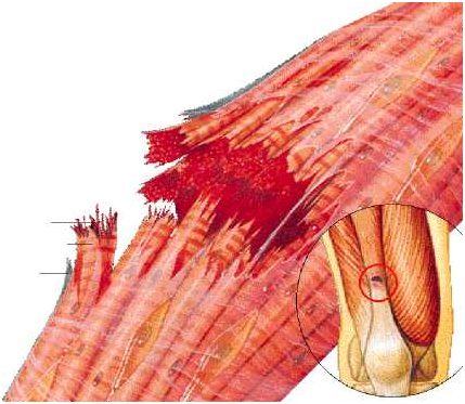 rotura muscular